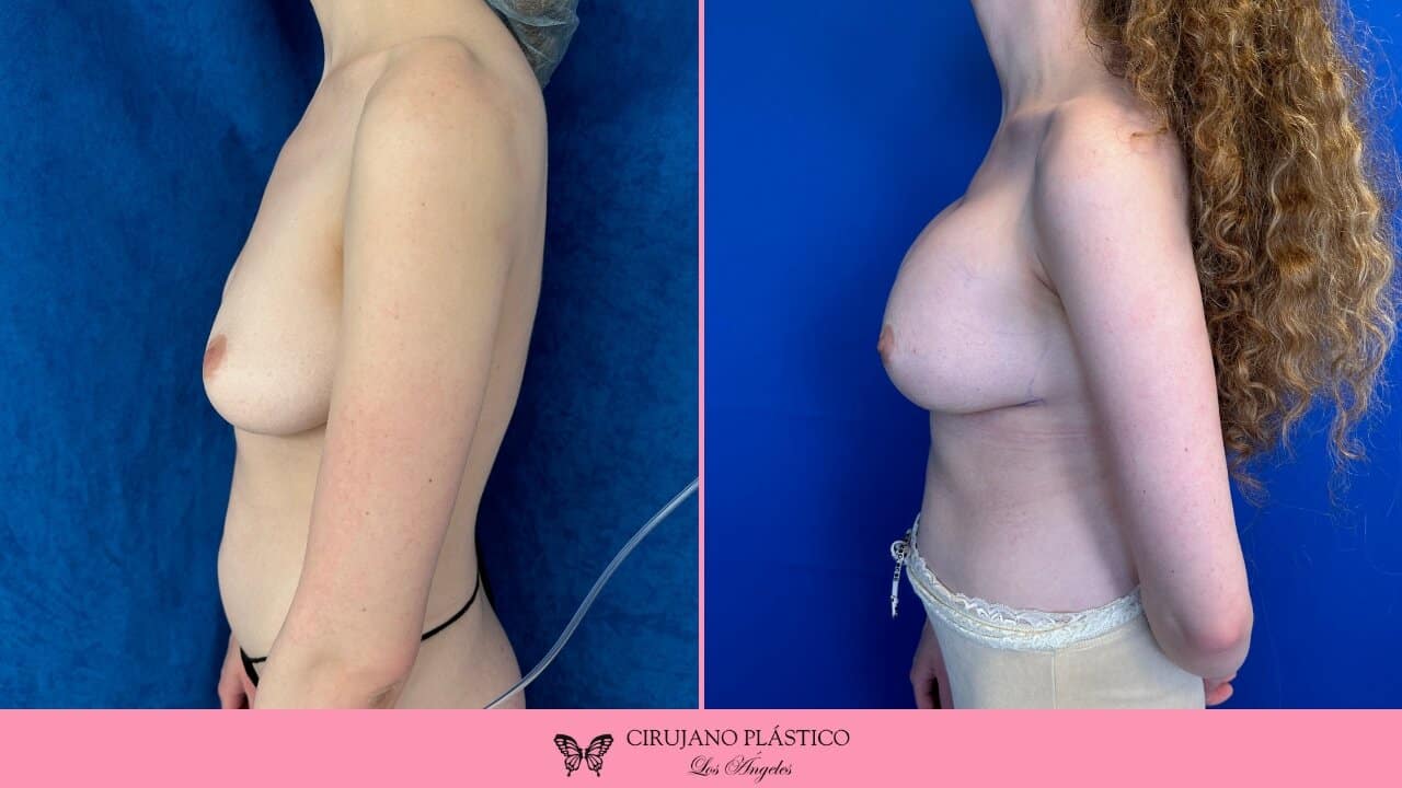 Breast Augmentation Before and After Patient 2a