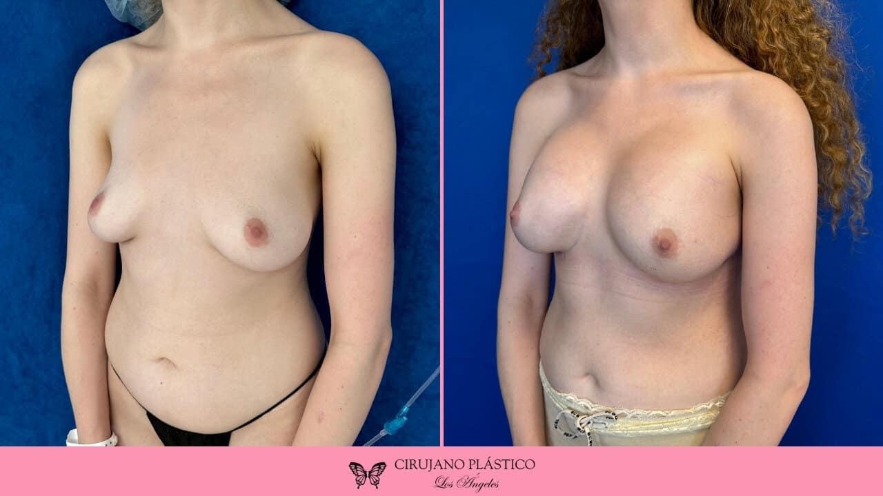 Breast Augmentation Before and After Patient 2c