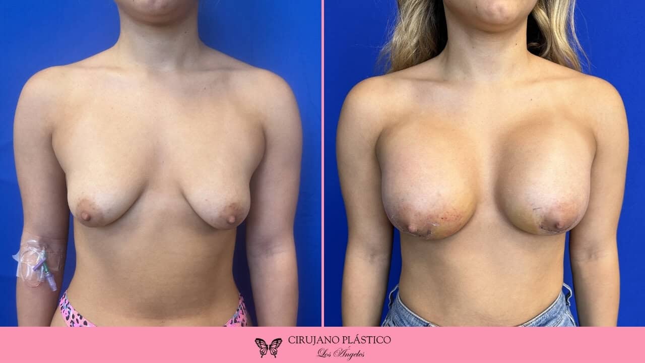 Breast Augmentation Before and After Patient 3a