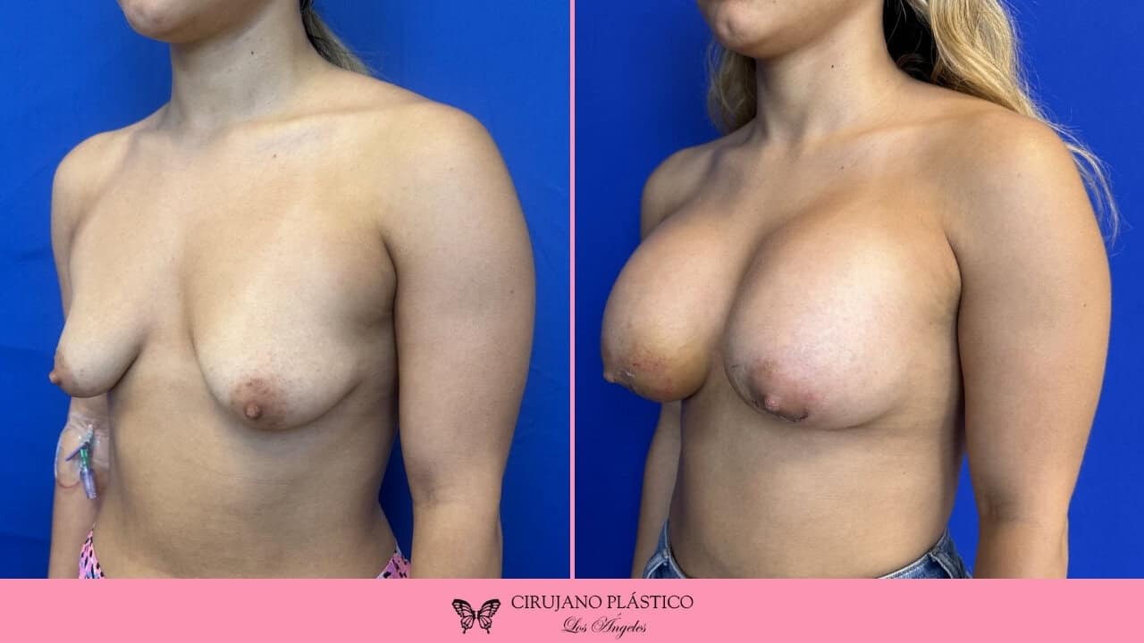 Breast Augmentation Before and After Patient 3b