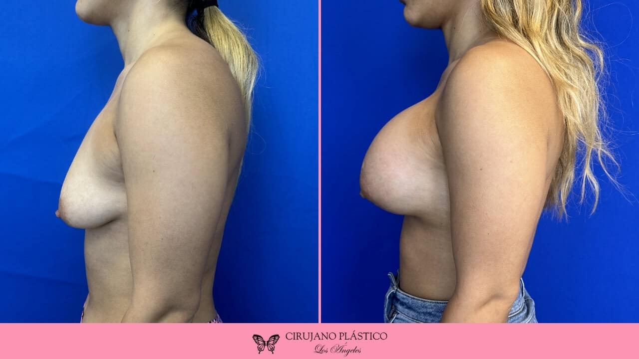 Breast Augmentation Before and After Patient 3c