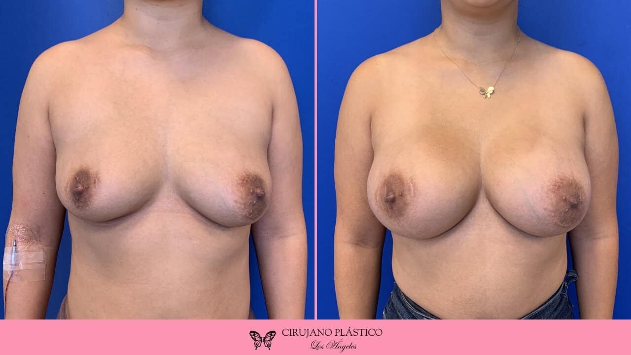 Breast Augmentation Before and After Patient 4a