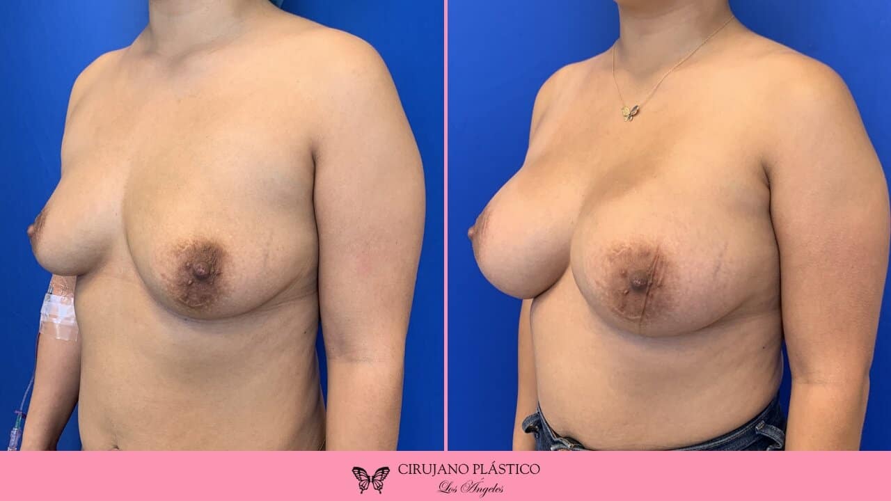 Breast Augmentation Before and After Patient 4b