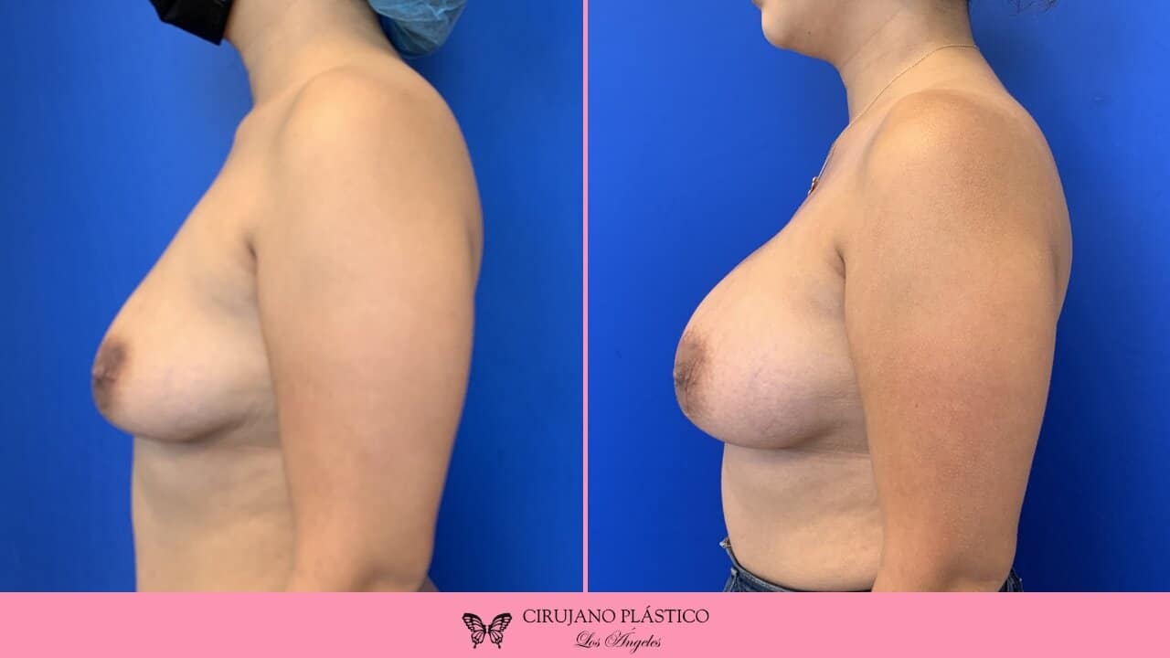Breast Augmentation Before and After Patient 4c