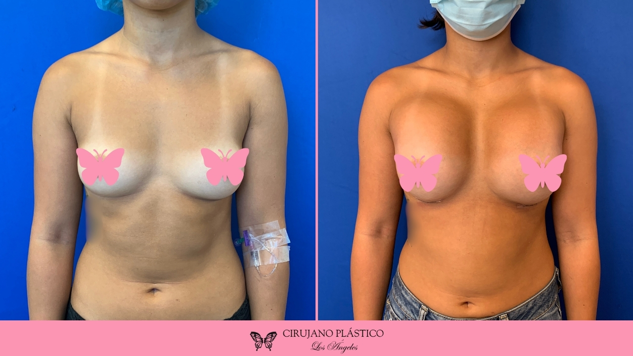 Breast Augmentation Before and After Patient A