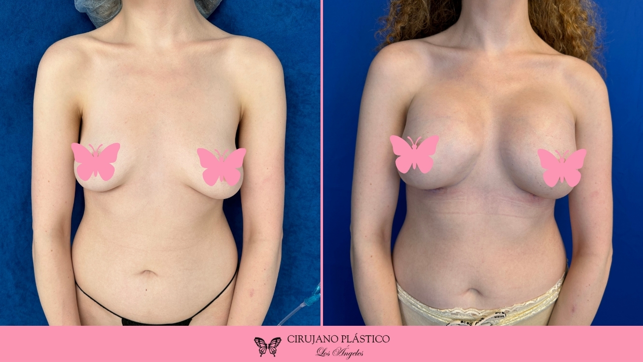Breast Augmentation Before and After Patient B