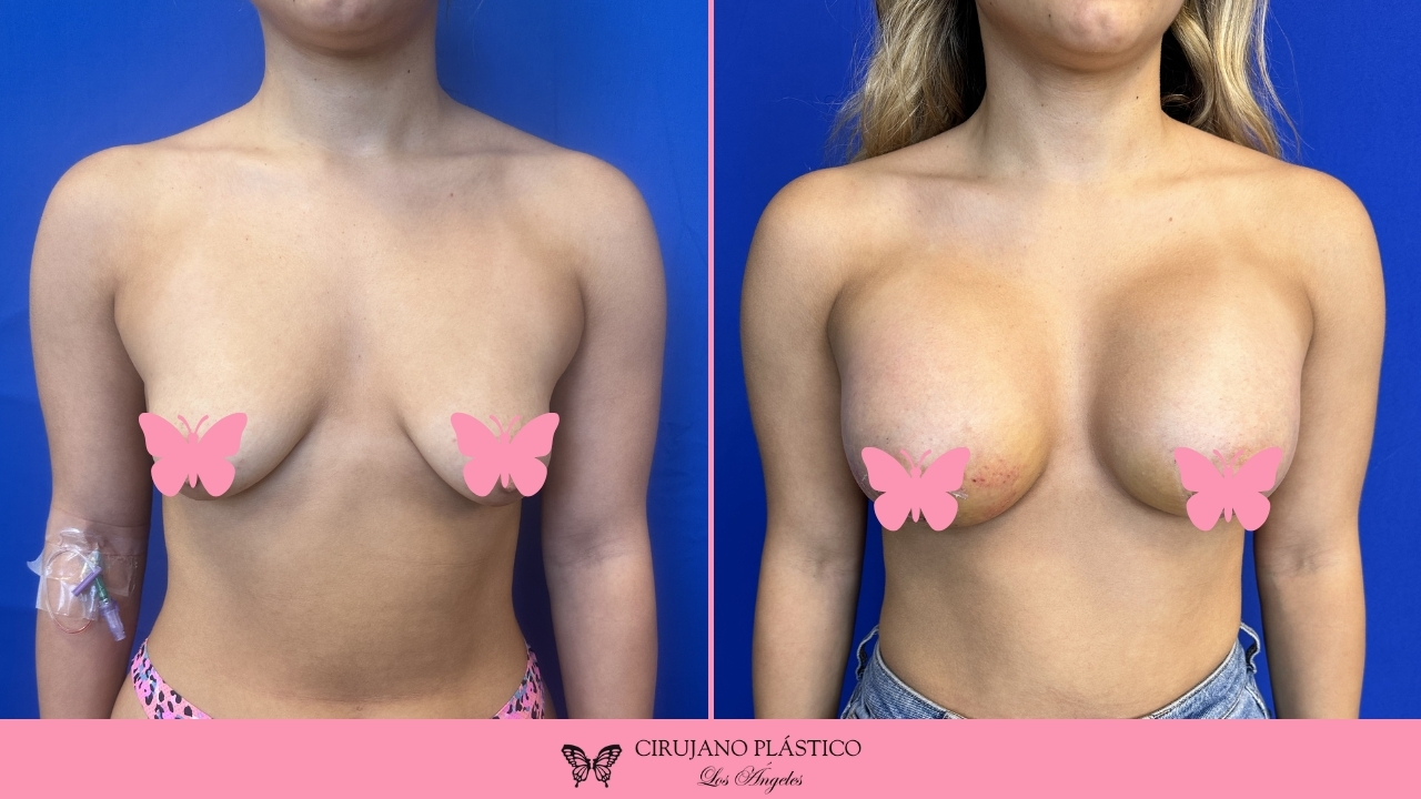 Breast Augmentation Before and After Patient C