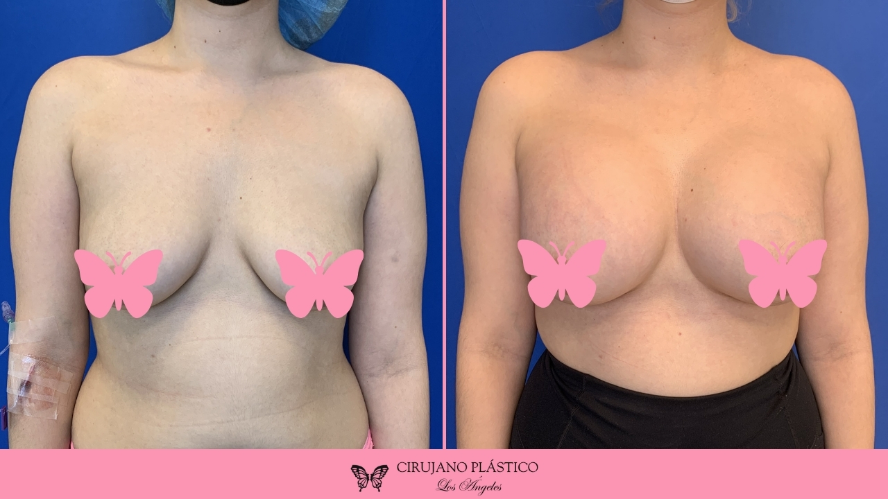 Breast Augmentation Before and After Patient E