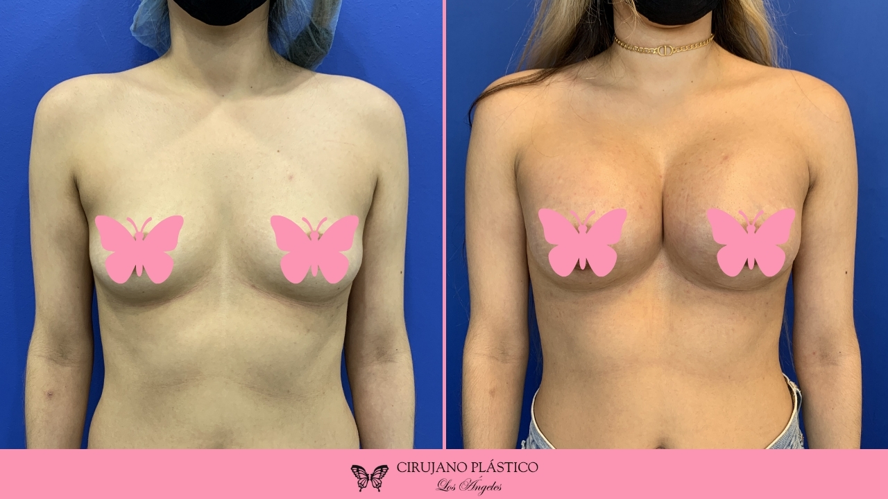 Breast Augmentation Before and After Patient F