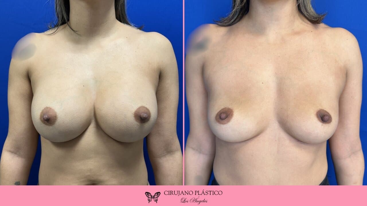 Breast Implant Removal Before and After Patient 1a