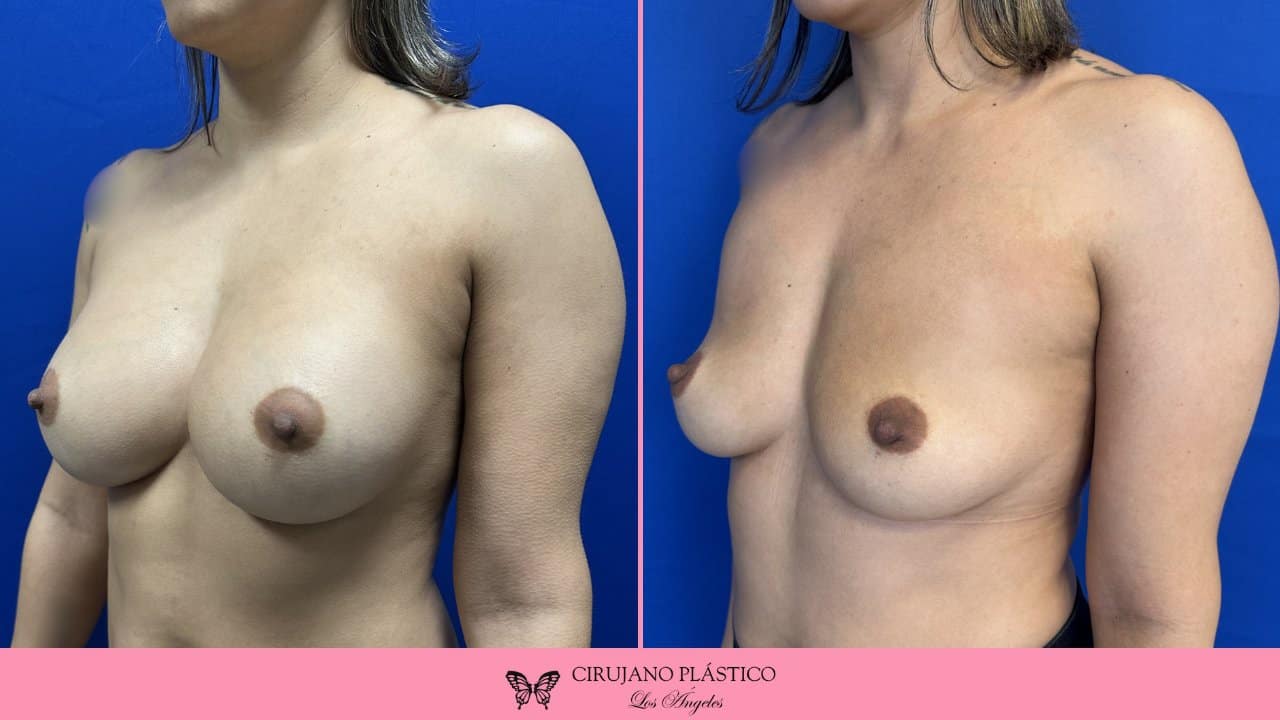Breast Implant Removal Before and After Patient 1b