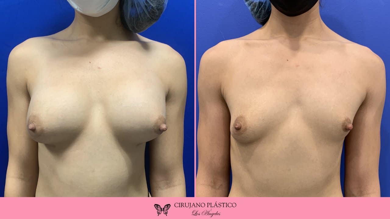 Breast Implant Removal Before and After Patient 4a