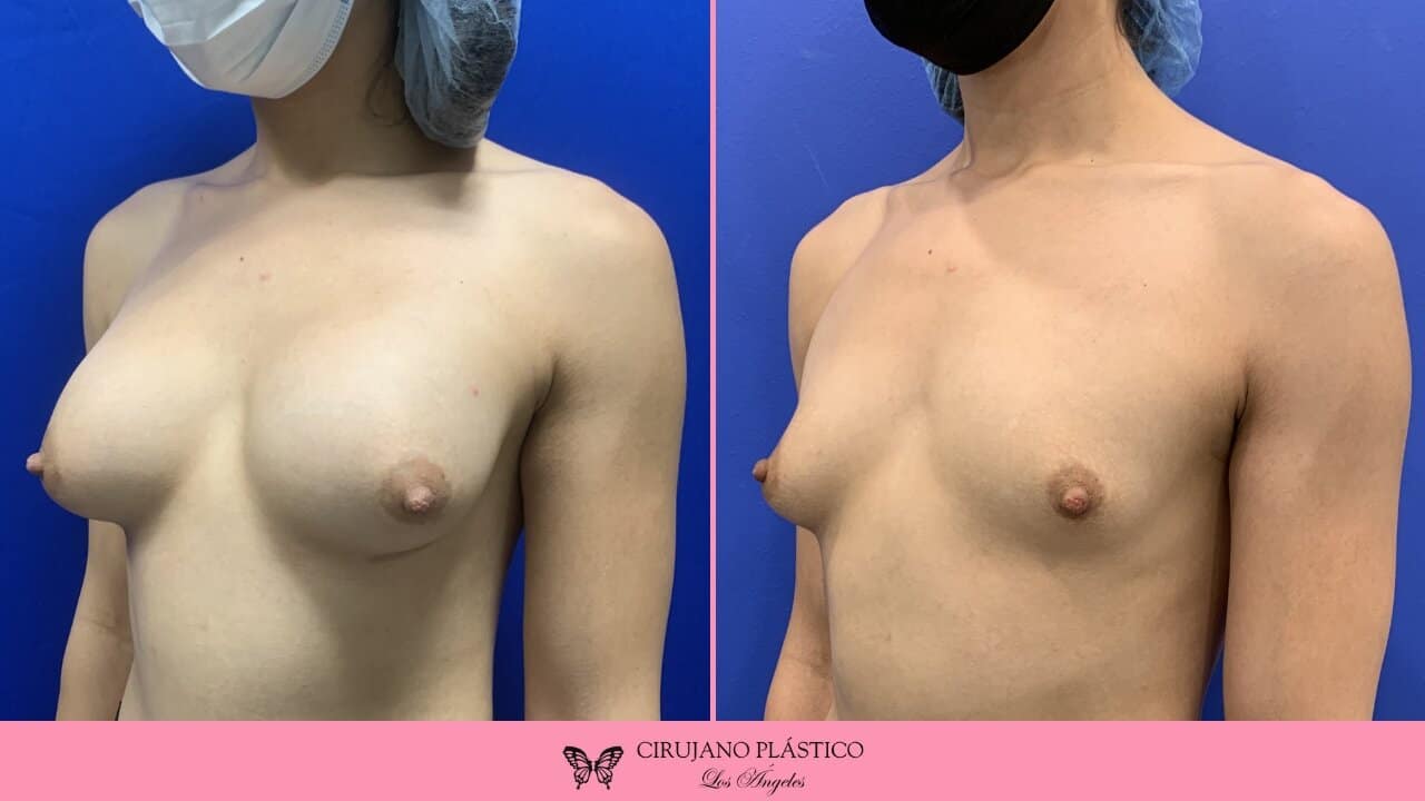 Breast Implant Removal Before and After Patient 4b