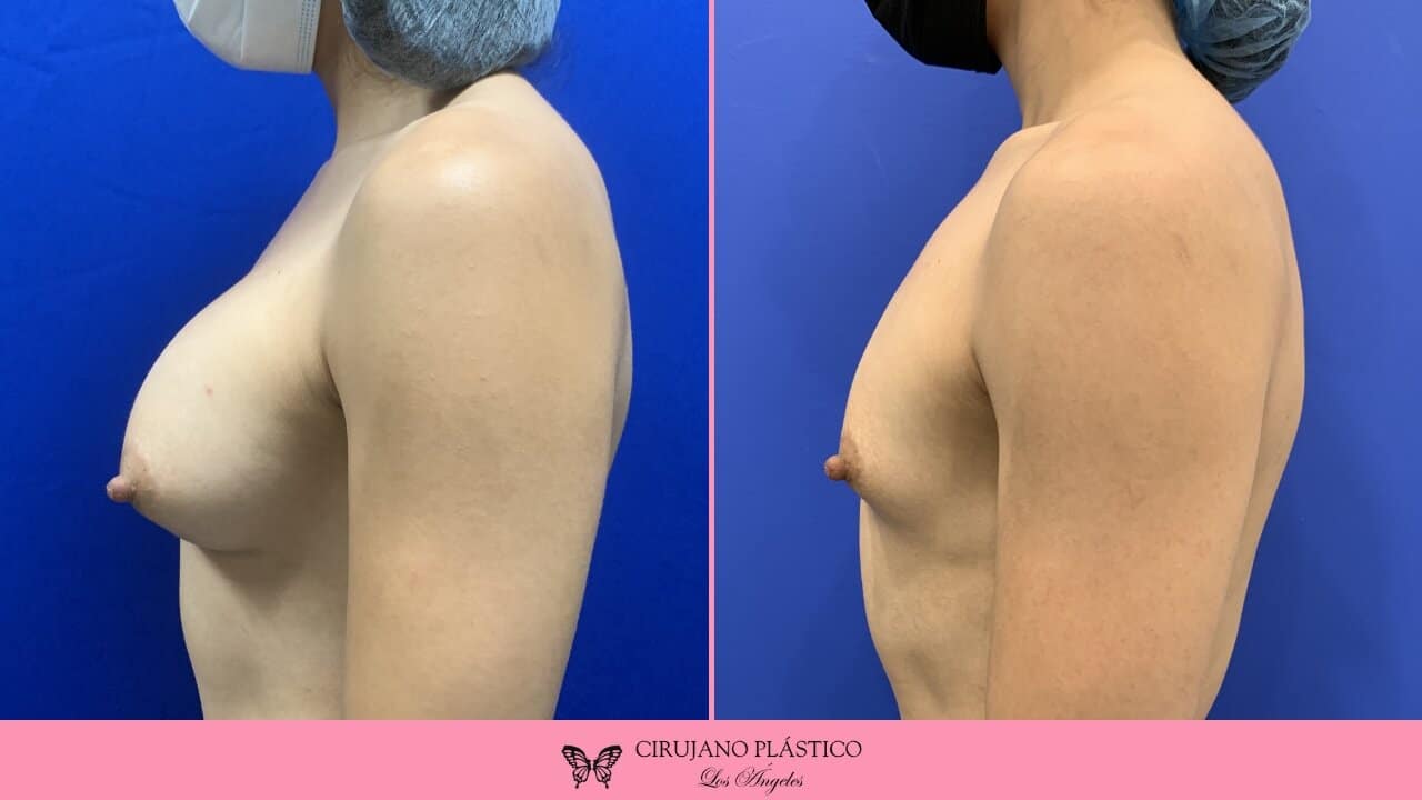 Breast Implant Removal Before and After Patient 4c