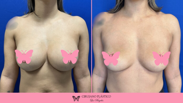 Breast Implant Removal Before and After Patient A