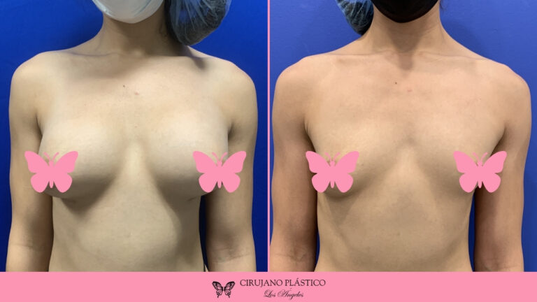 Breast Implant Removal Before and After Patient B