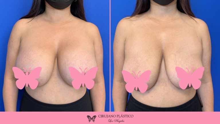 Breast Implant Removal Before and After Patient C