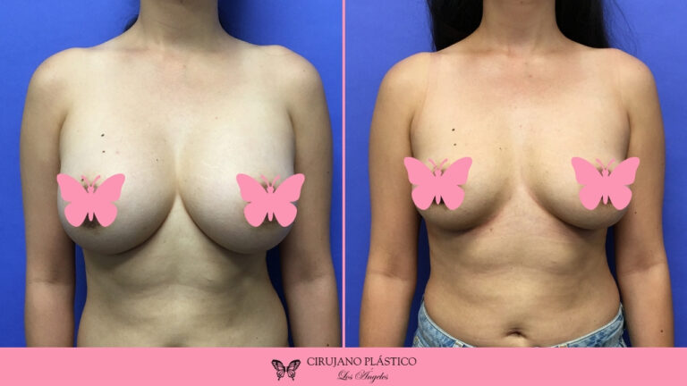 Breast Implant Removal Before and After Patient D