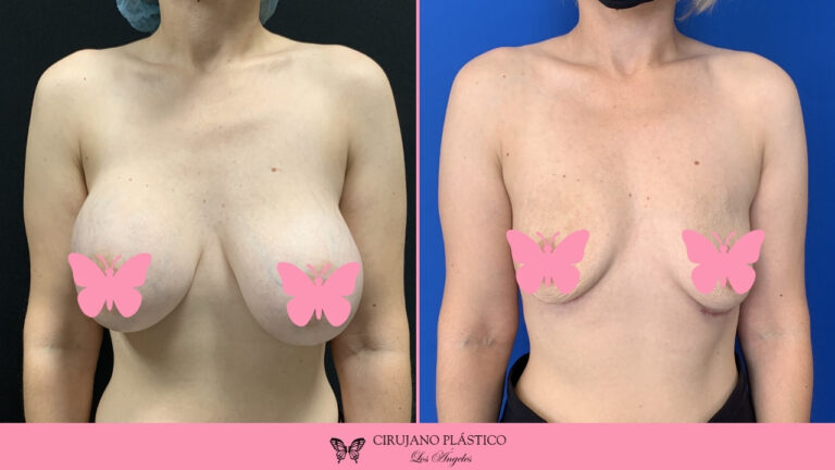 Breast Implant Removal Before and After Patient E