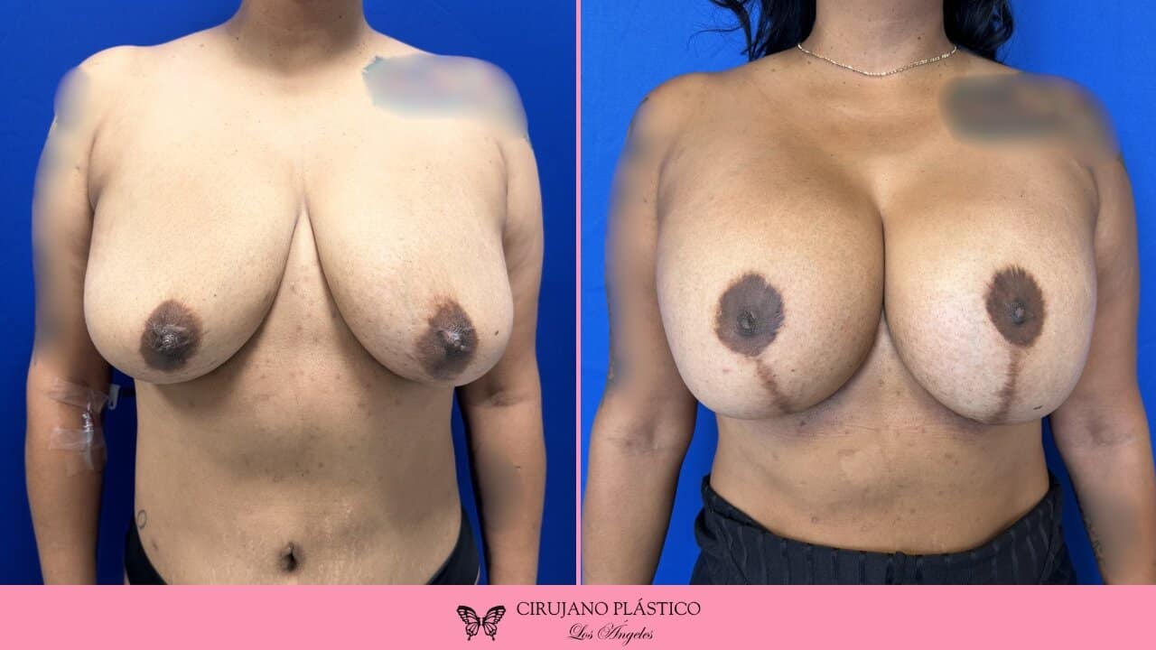 Breast Lift Before and After Patient 3a