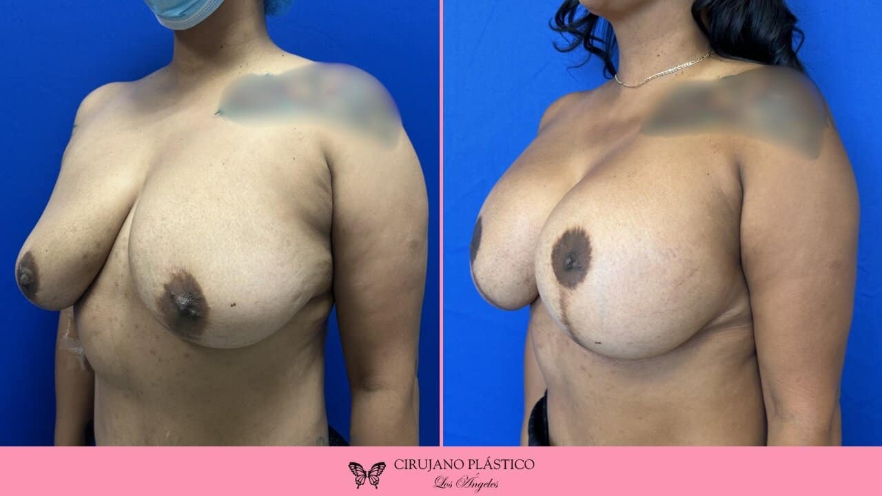 Breast Lift Before and After Patient 3b