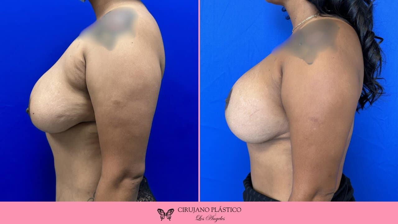Breast Lift Before and After Patient 3c
