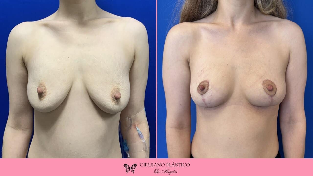 Breast Lift Before and After Patient 4a