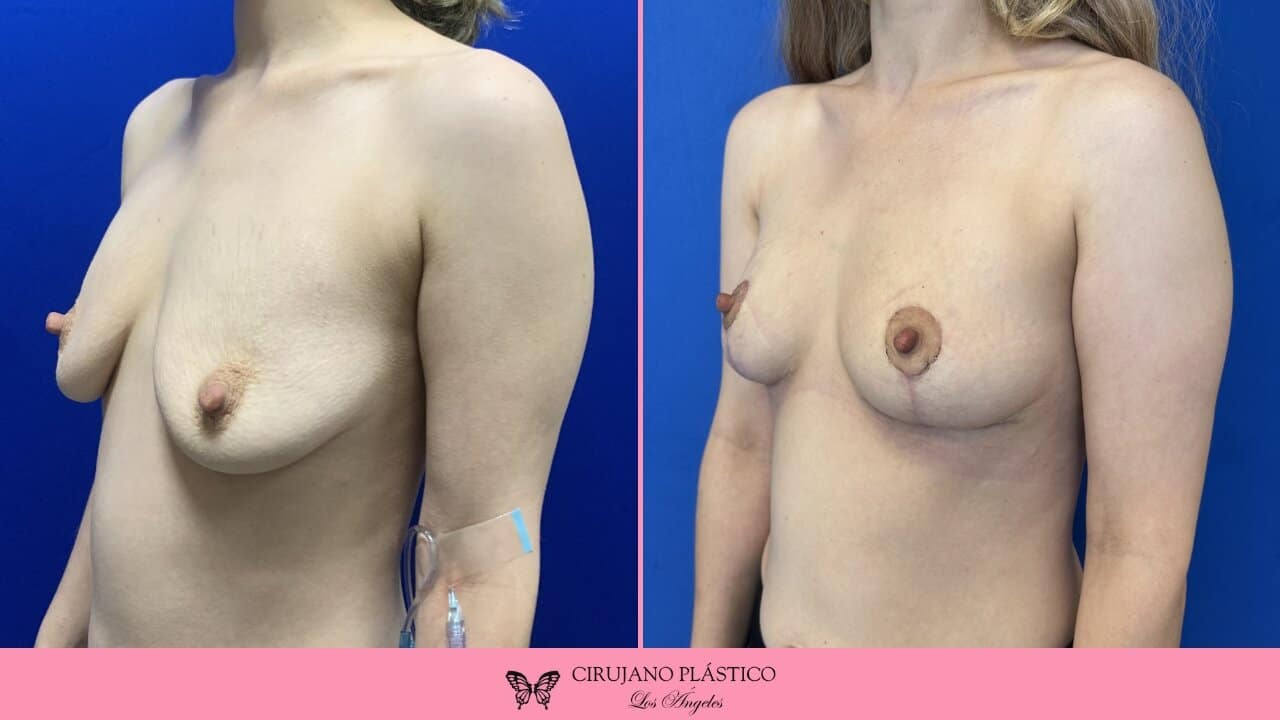 Breast Lift Before and After Patient 4b