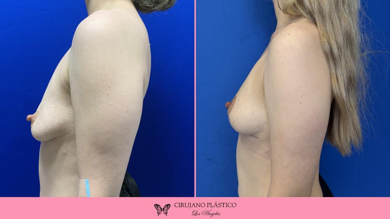 Breast Lift Before and After Patient 4c