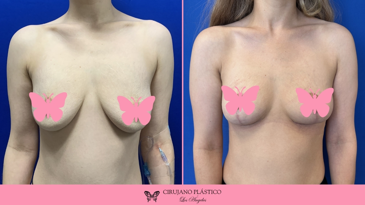 Breast Lift Before and After Patient C