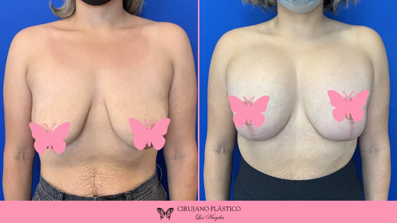 Breast Lift Before and After Patient D