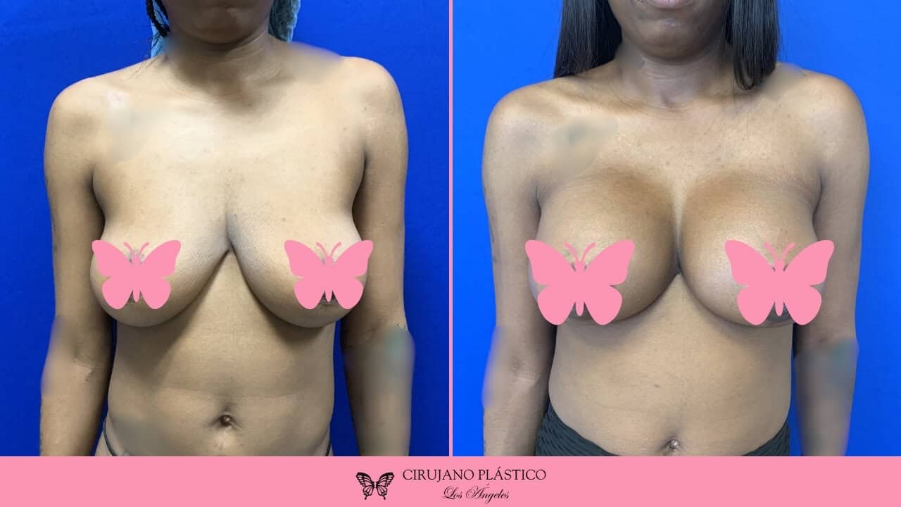 Breast Lift Before and After Patient E