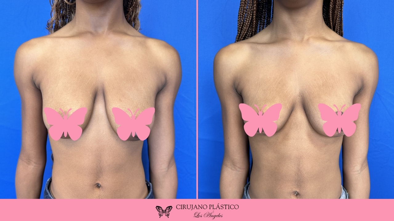 Breast Lift Before and After Patient F