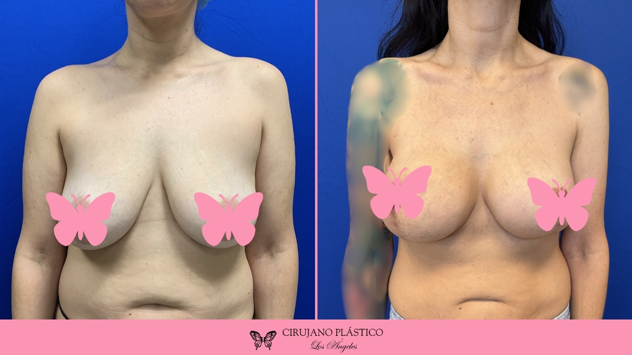 Breast Lift Before and After Patient G