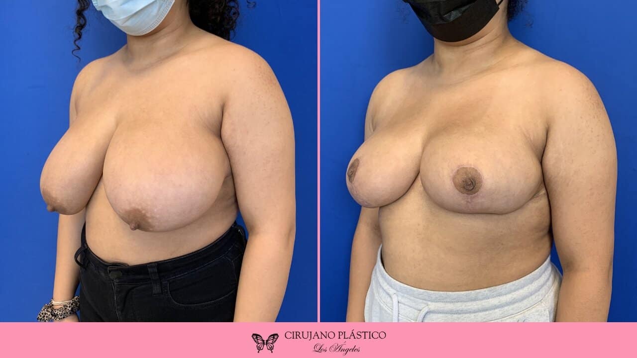Breast Reduction Before and After Patient 1b