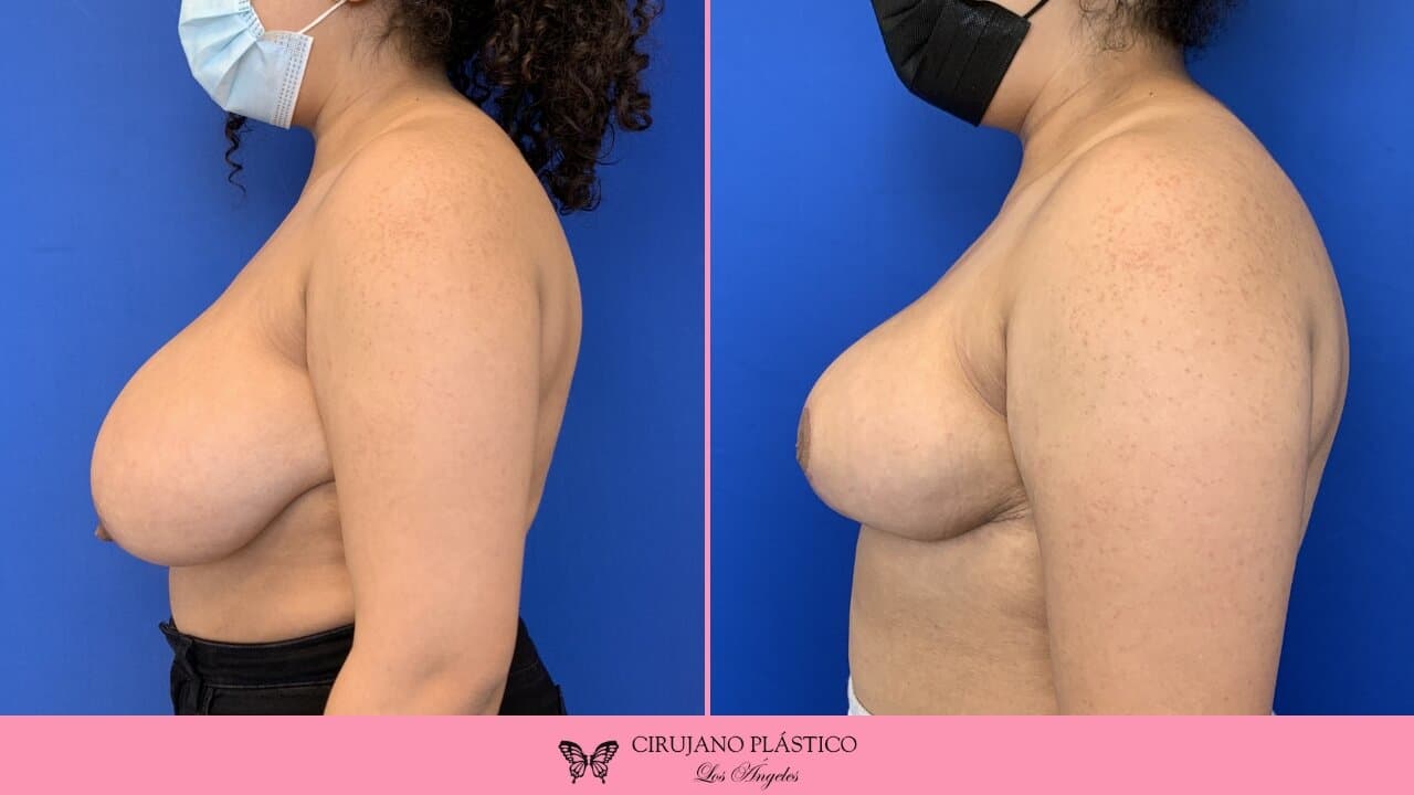 Breast Reduction Before and After Patient 1c