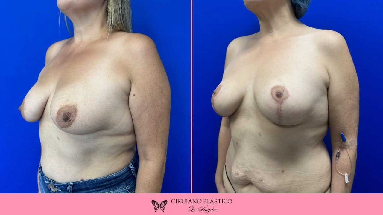 Breast Reduction Before and After Patient 3b