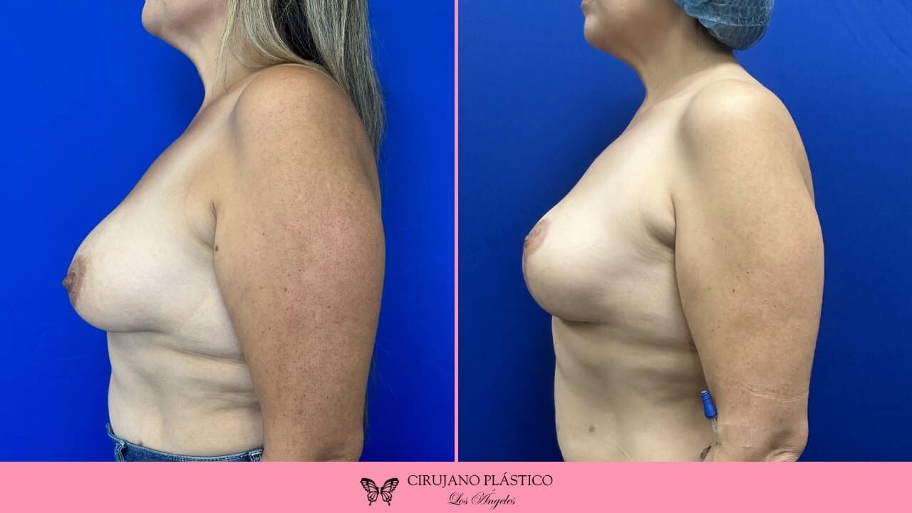Breast Reduction Before and After Patient 3c