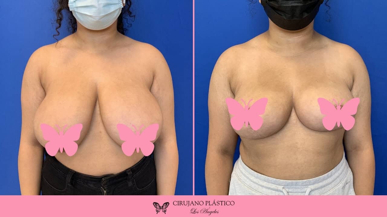 Breast Reduction Before and After Patient A