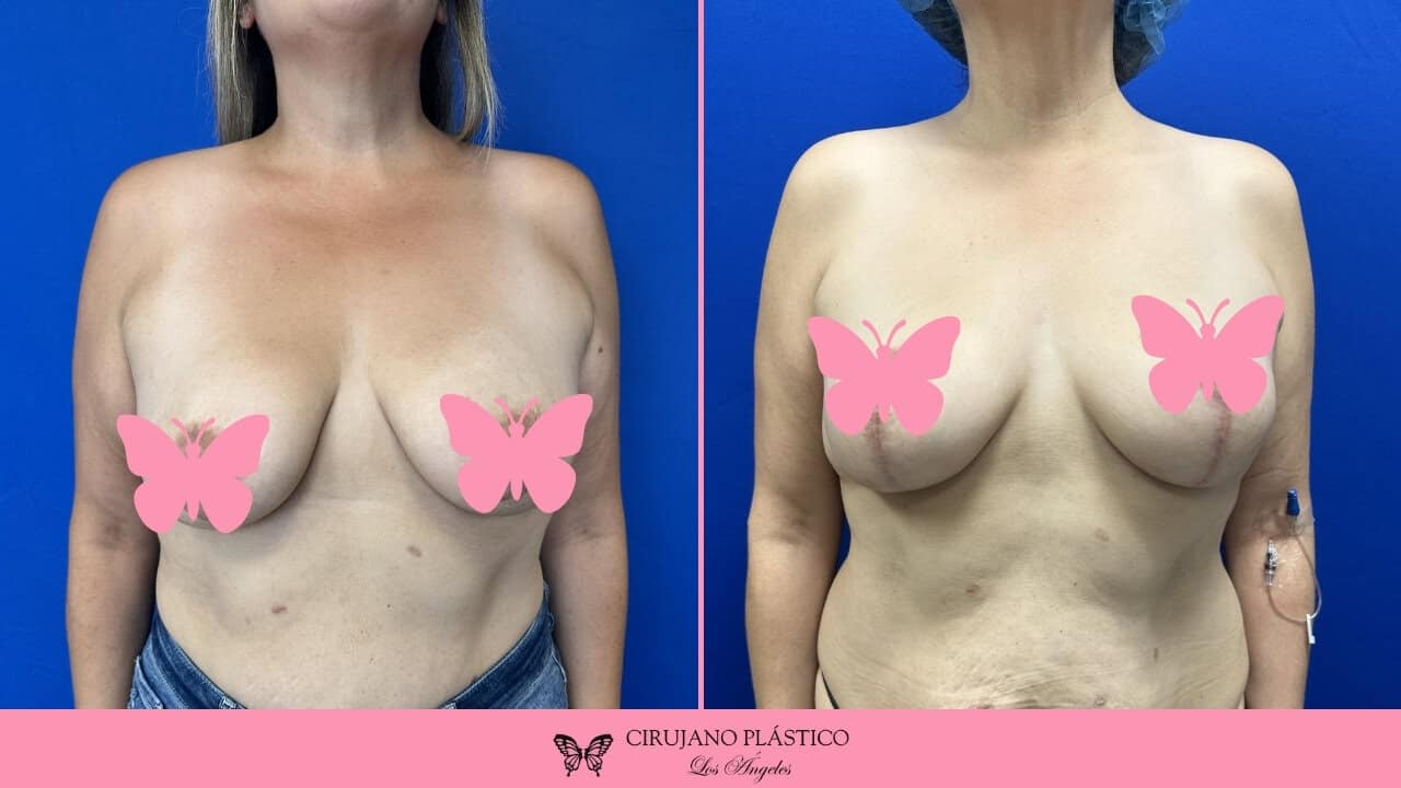 Breast Reduction Before and After Patient B