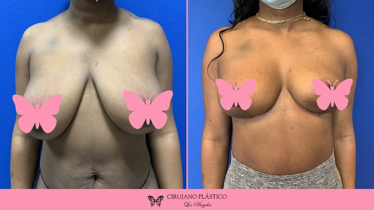 Breast Reduction Before and After Patient C
