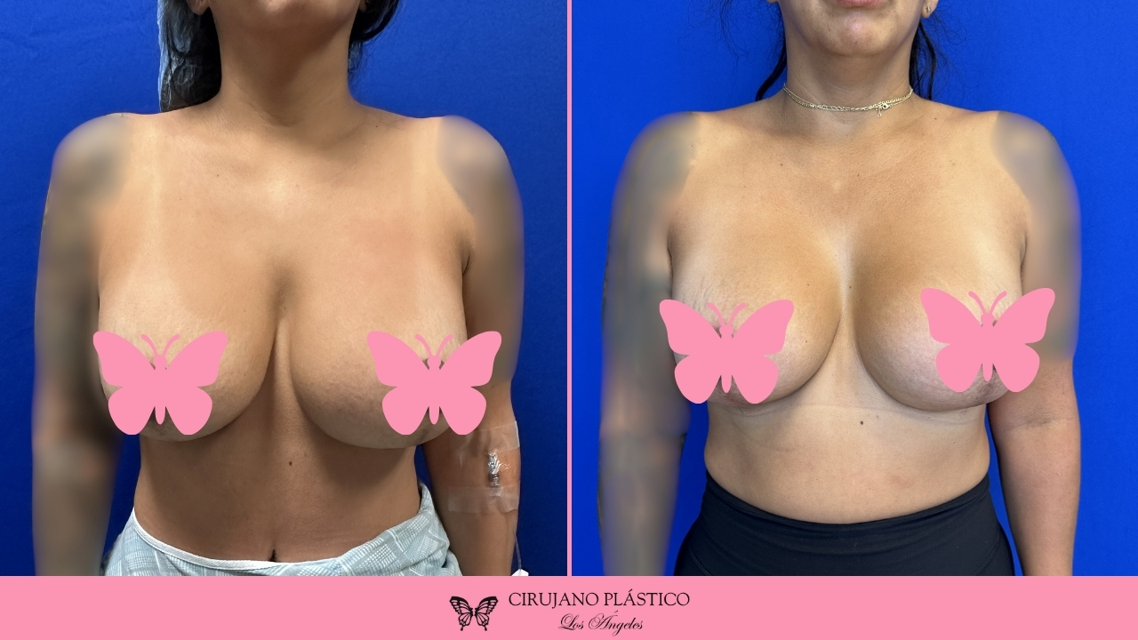 Breast Reduction Before and After Patient D