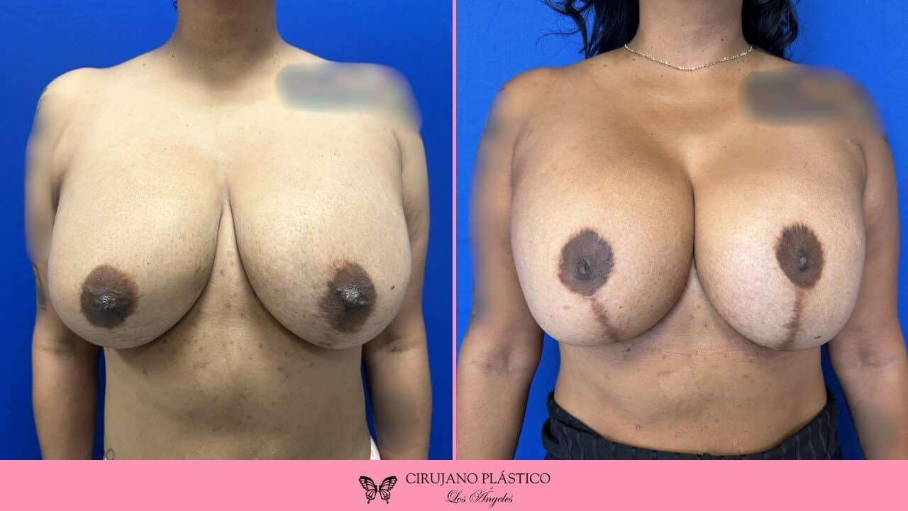 Breast Revision Before and After Patient 3a