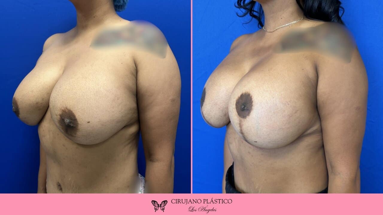 Breast Revision Before and After Patient 3b
