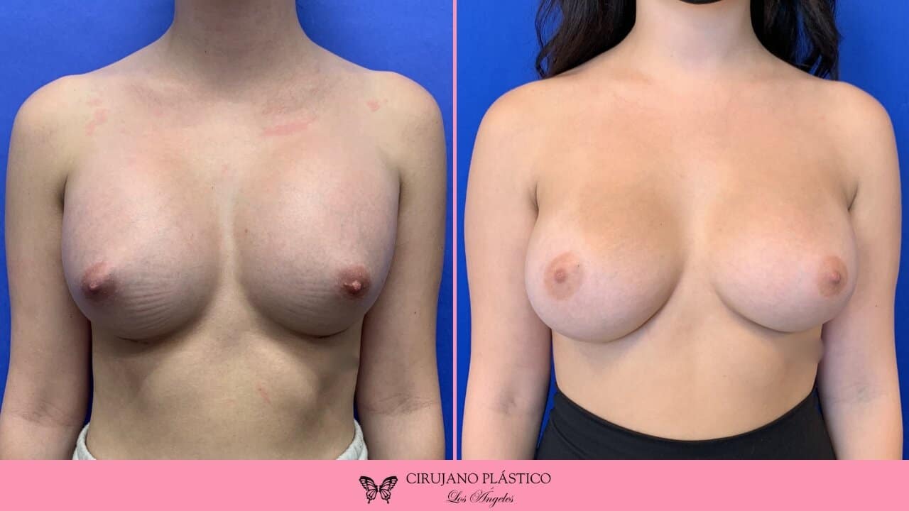 Breast Revision Before and After Patient 4a