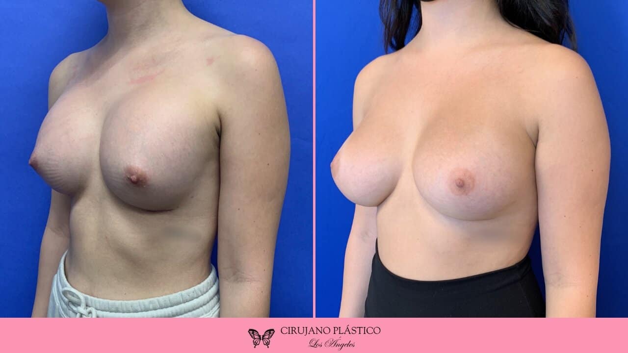 Breast Revision Before and After Patient 4b