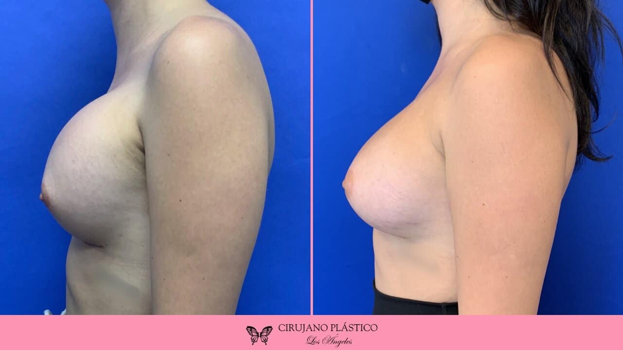 Breast Revision Before and After Patient 4c