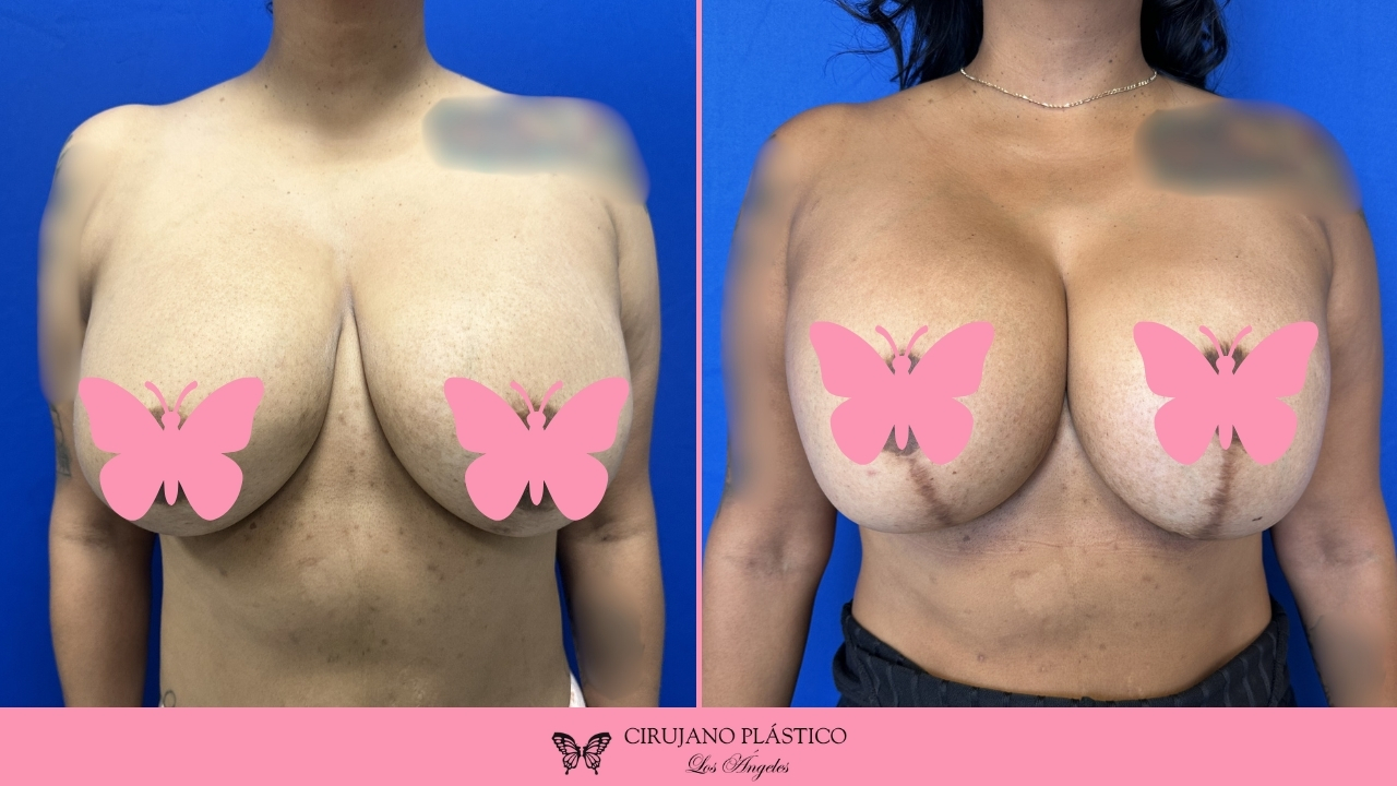 Breast Revision Before and After Patient A