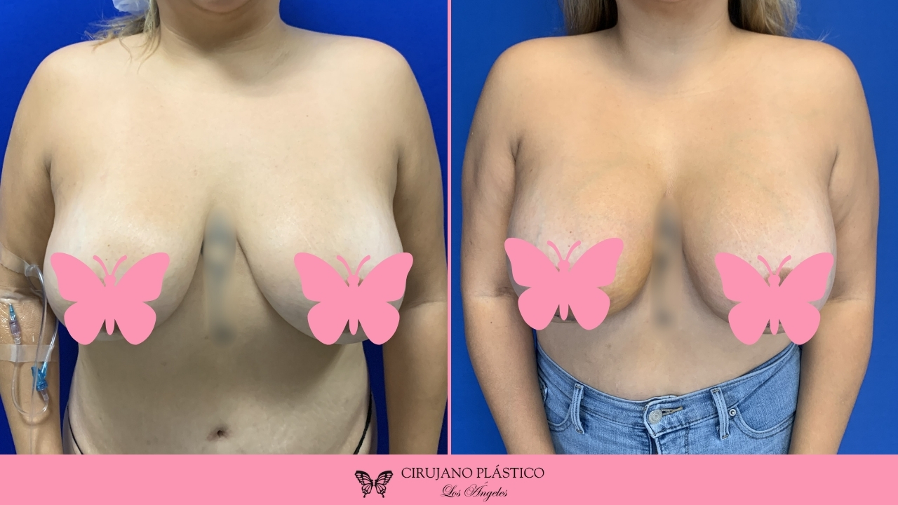 Breast Revision Before and After Patient C