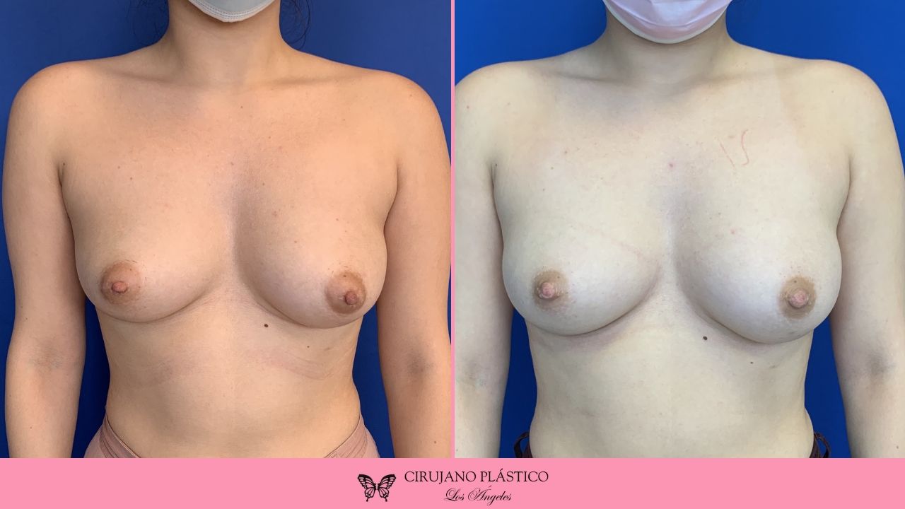 Nipple Sugery Before and After Patient 1a